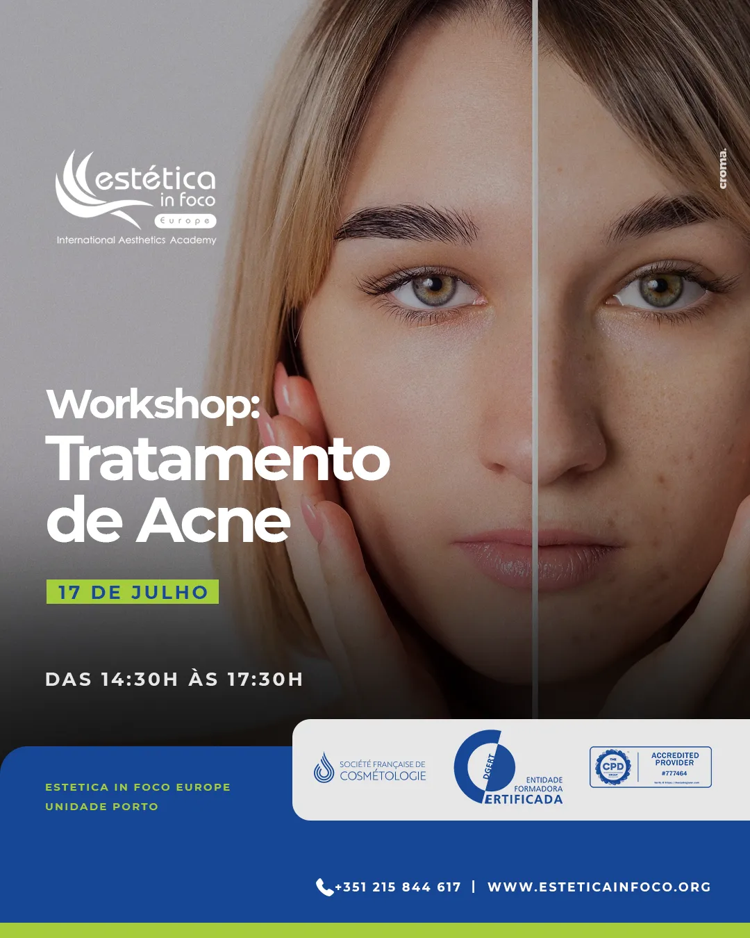 Workshop Tratamento de Acne – Porto – 17 Julho